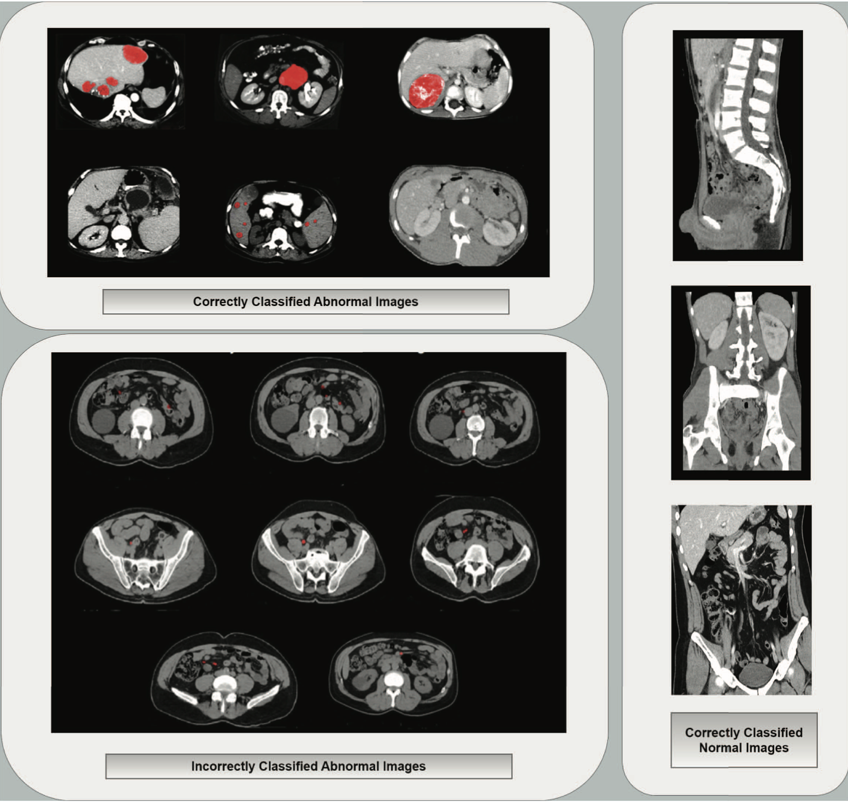 Generating Synthetic Computed Tomography (CT) Images to Improve the Performance of Machine Learning Model for Pediatric Abdominal Anomaly Detection